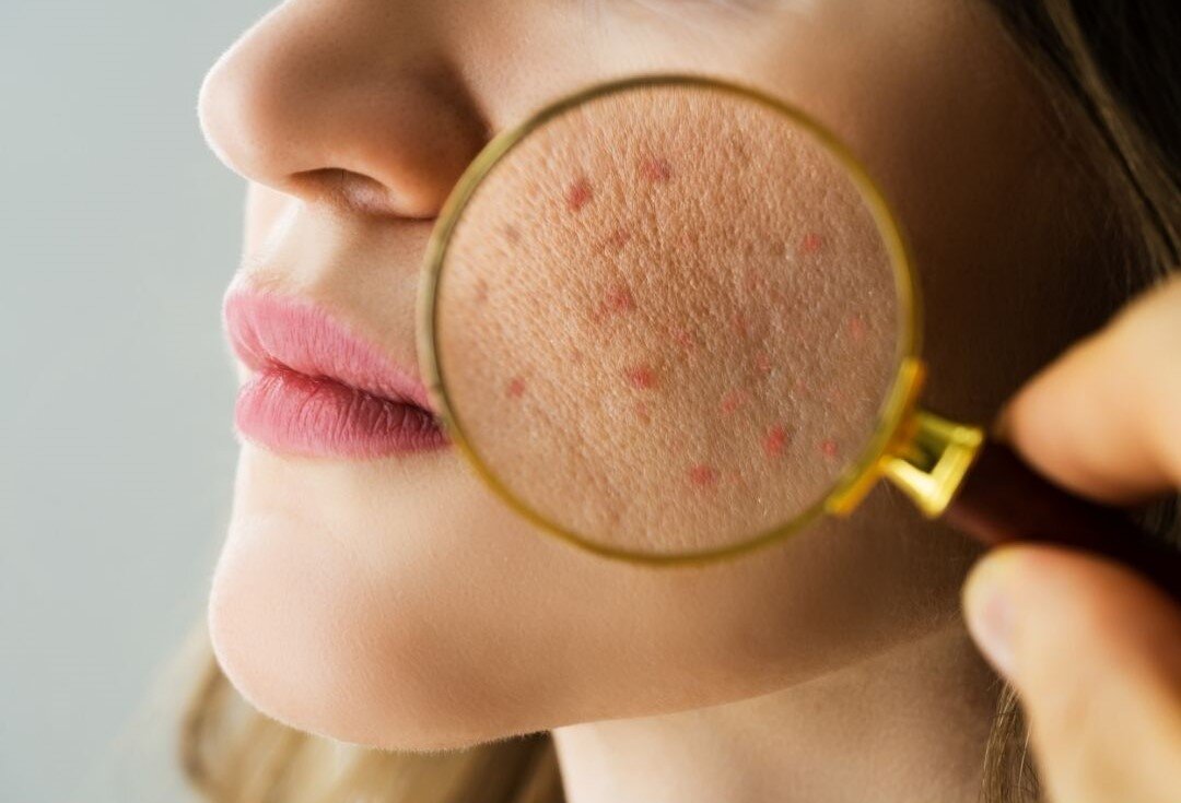 Akné v dospelosti: Prečo vzniká a ako sa ho zbaviť v BIO kvalite s Bione Cosmetics, akné po 30-tke