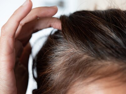 Je transplantácia vlasových folikul odpoveďou na vypadávanie vlasov?