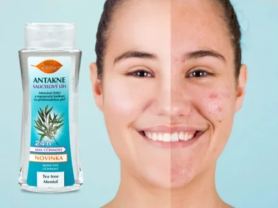Niacinamid: ingrediencia, ktorú si zamilovala mastná aj citlivá pleť